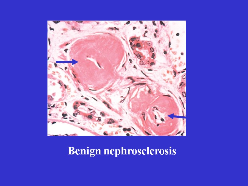Benign nephrosclerosis